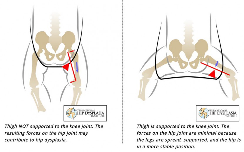 the international hip dysplasia institute diagram above shows how...