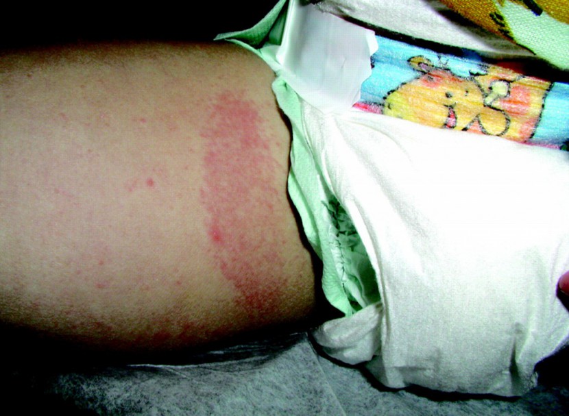 this photo appears in diaper dye dermatitis, a study published in...