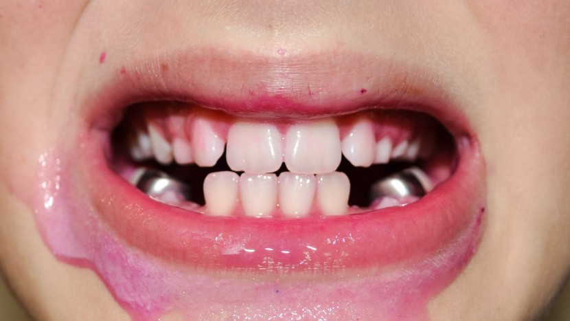 the dsnly does such a good job it's hard to tell his teeth were ever...