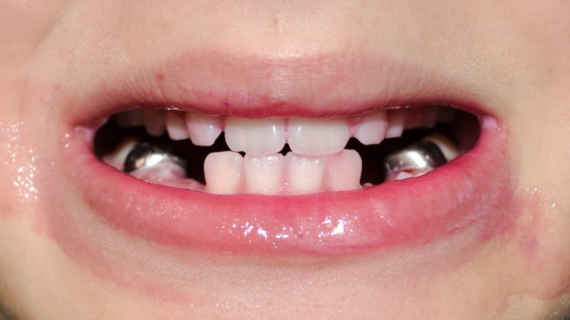 it is clear to see that the oral-b removed the plaque and the dye...