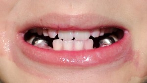 It is clear to see that the Oral-B removed the plaque and the dye...