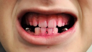 The before brushing dye job prior to using the Oral-B.