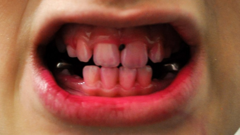 electric toothbrush kids - we dyed our plaque and grit purple to see how well each brush could...